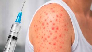 Sarampión repunta en México con más de 14 mil casos