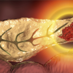 cancer_de_pancreas_blog_version_escritorio
