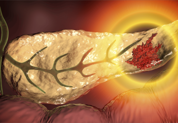 cancer_de_pancreas_blog_version_escritorio